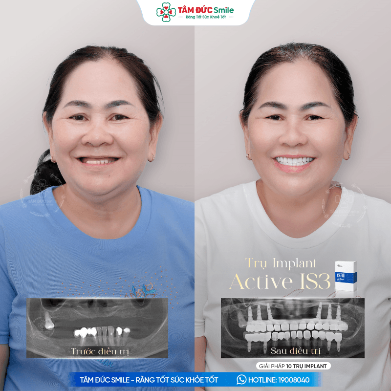 tru-implant-active-is3-8