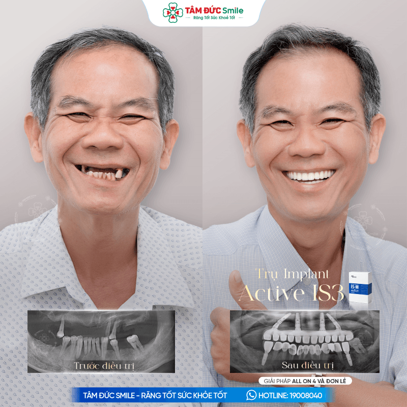 tru-implant-active-is3-9