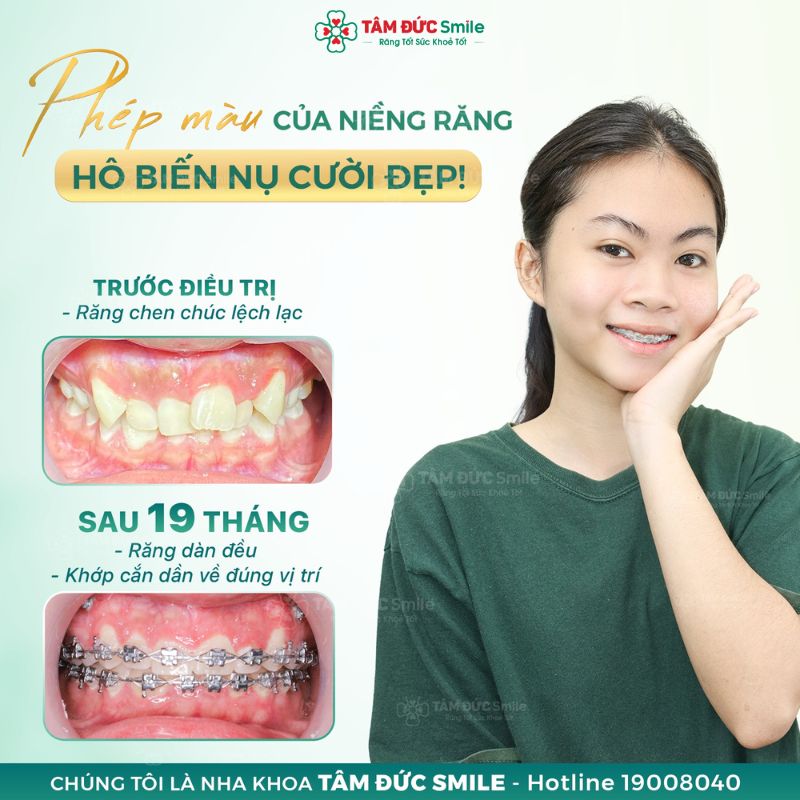 Niềng răng khi 25 tuổi có thể cần nhiều thời gian hơn