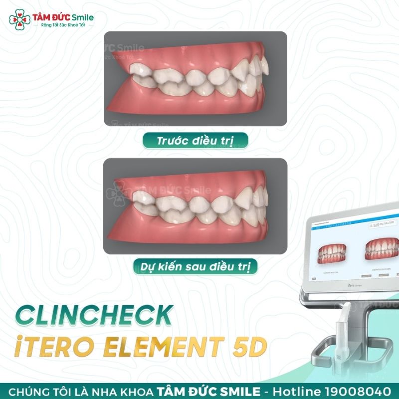 Công nghệ ClinCheck tại Nha khoa Tâm Đức Smile giúp Quý khách hình dung trước kết quả chỉnh nha