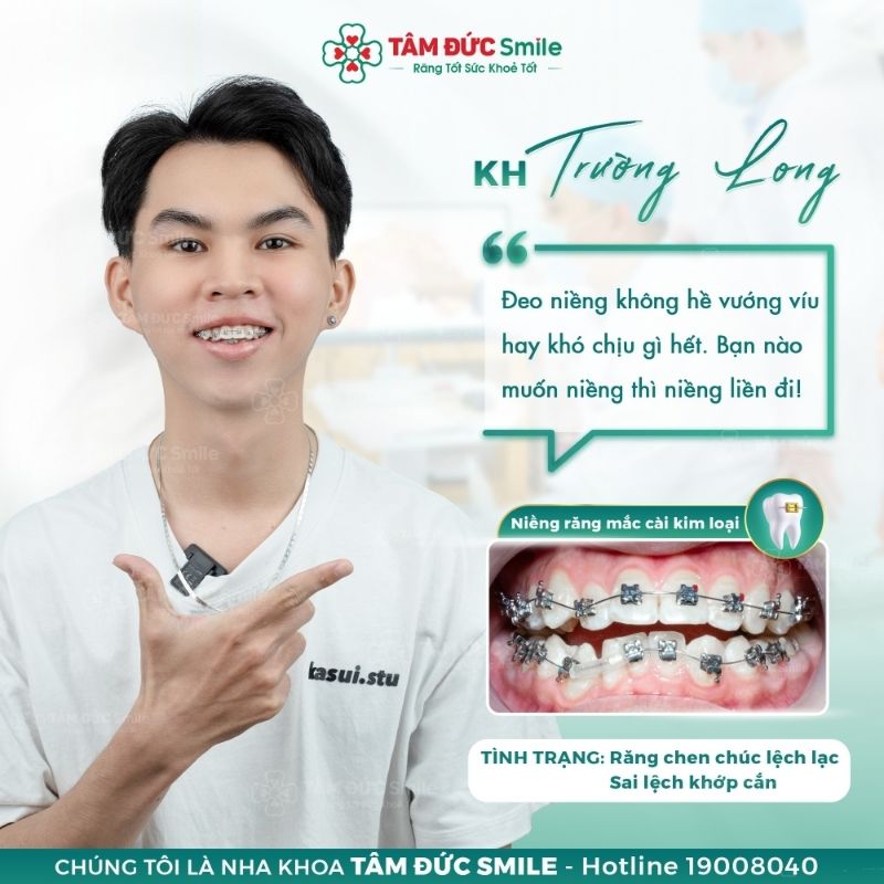 Thời gian niềng răng ở tuổi 25 phụ thuộc vào nhiều yếu tố