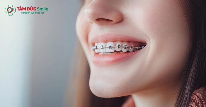 niềng răng ở tuổi 25 hoàn toàn khả thi và hiệu quả điều trị vẫn cao