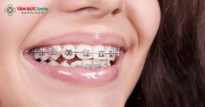 Người 34 tuổi vẫn có thể niềng răng hiệu quả