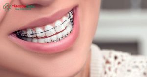 Người 42 tuổi vẫn có thể niềng răng để cải thiện thẩm mỹ nụ cười