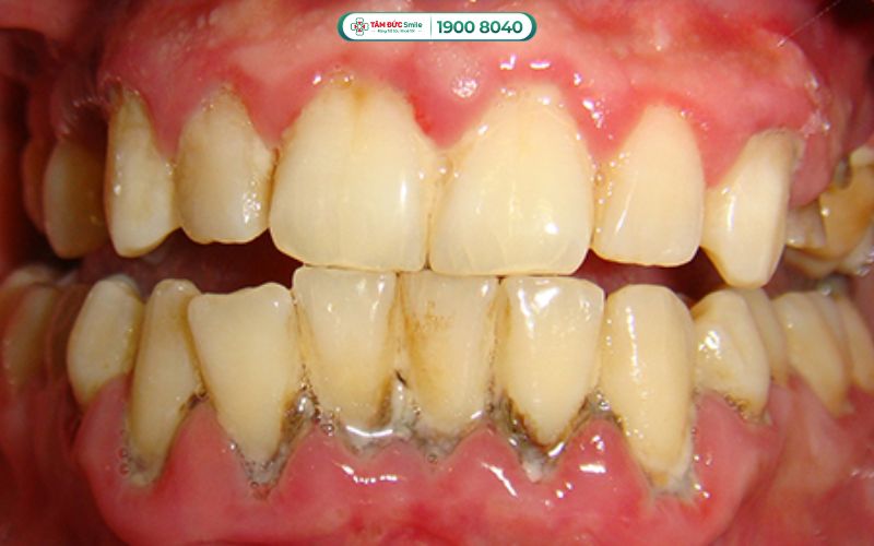 Giảm nguy cơ sâu răng – viêm nướu