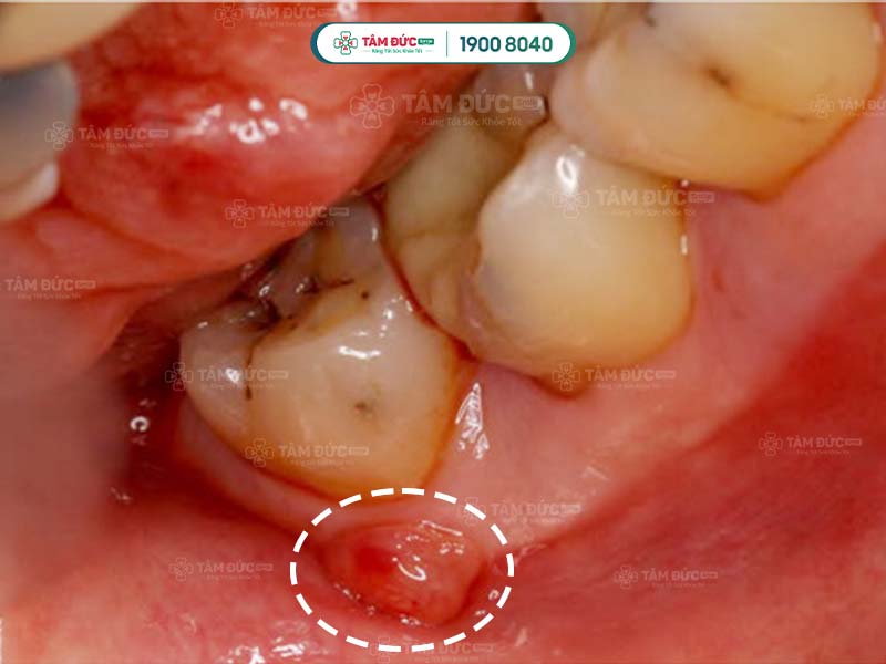 Áp xe răng khôn cảnh báo nhiễm trùng đang lan rộng