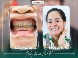 Thông thường, bọc răng sứ phù hợp hơn với người từ 18 tuổi trở lên, khi răng vĩnh viễn, xương hàm và khớp cắn đã phát triển ổn định