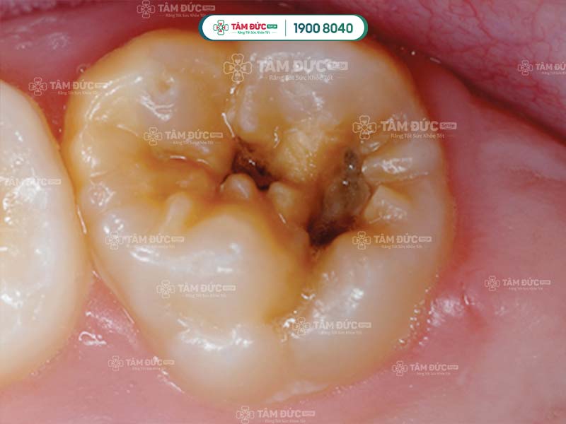 Sâu răng dễ dàng lây lan từ răng này sang răng khác