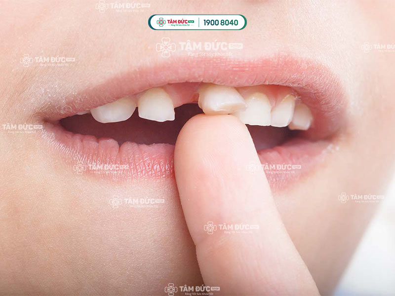 Cách nhổ răng lung lay cần được xác định dựa trên nguyên nhân, mức độ lung lay và tình trạng chân răng