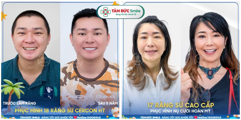 Nhu cầu bọc răng sứ thẩm mỹ tại TPHCM đang ngày càng tăng cao