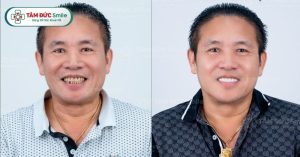 Nhu cầu bọc răng sứ thẩm mỹ tại TPHCM đang ngày càng tăng cao
