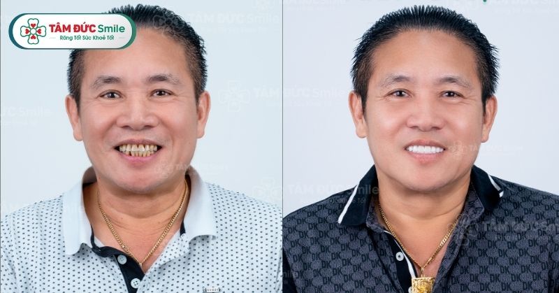 Nhu cầu bọc răng sứ thẩm mỹ tại TPHCM đang ngày càng tăng cao