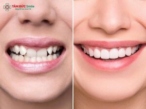 Bọc sứ giúp cải thiện thẩm mỹ và bảo vệ răng hiệu quả