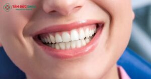 Bọc răng sứ cho răng hô là giải pháp thẩm mỹ tức thì