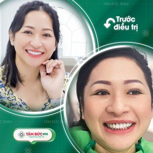 Răng sứ giúp cải thiện tình trạng ố vàng, sẫm màu răng