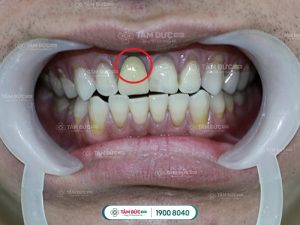 Răng sứ kim loại bị đen viền nướu sau một thời gian sử dụng