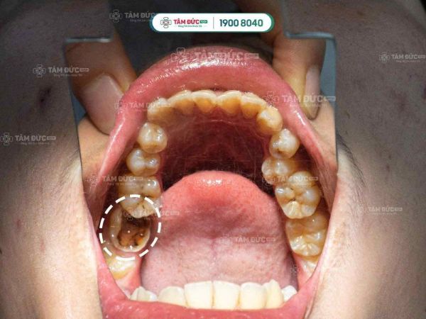 Sâu răng làm vỡ bề mặt răng gây ảnh hưởng chức năng nhai