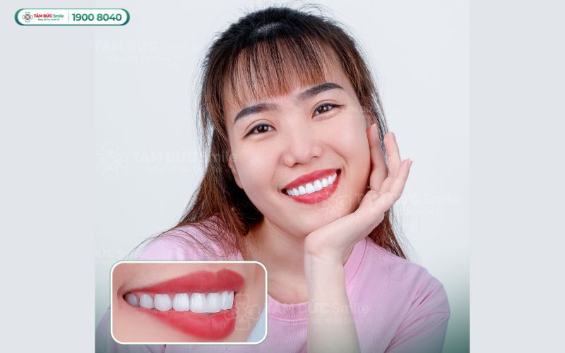 Răng của khách vẫn trắng đẹp sau 2 năm làm răng sứ tại Tâm Đức Smile