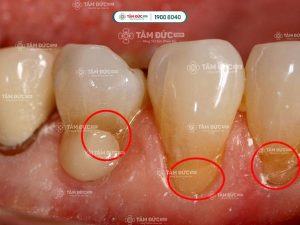 Lộ ngà răng làm tăng nguy cơ bị sâu và viêm nhiễm quanh chân răng