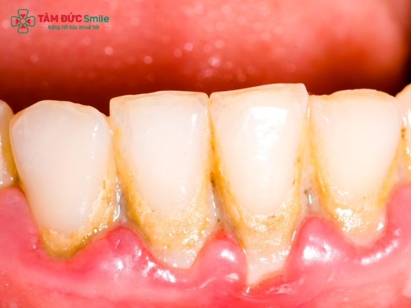 Cao răng là gì? Quy trình lấy cao răng tại nha khoa diễn ra như thế nào?