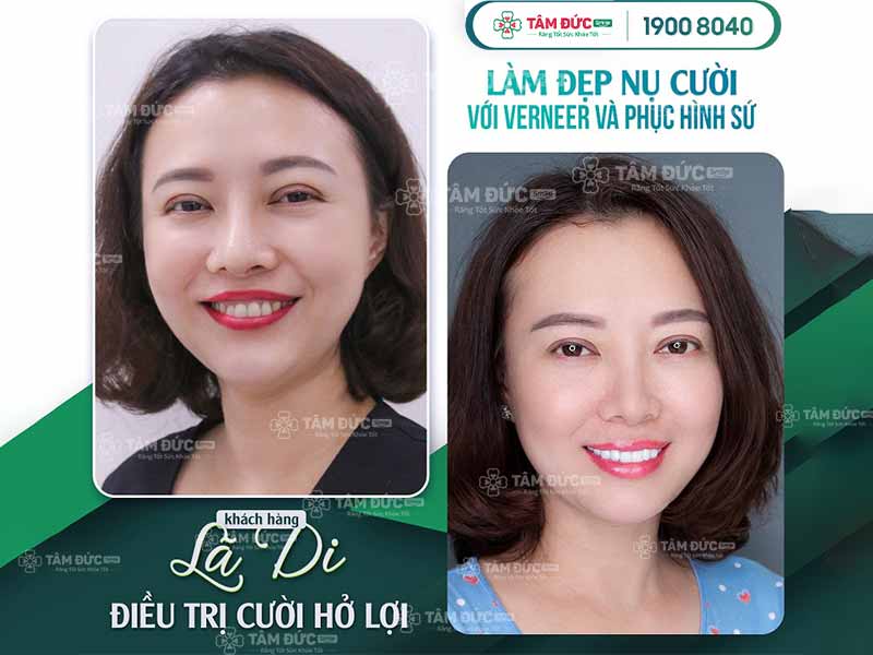 Chị Lã Di cắt nạo chóp răng điều trị cười hở lợi tại nha khoa Tâm Đức Smile