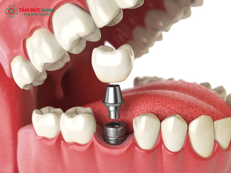 Cấy ghép Implant sử dụng trụ Titanium thay thế chân răng đã mất, kết hợp Abutment và mão sứ để phục hồi răng hoàn chỉnh tại Nha khoa Tâm Đức Smile.
