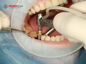 Cấy ghép Implant