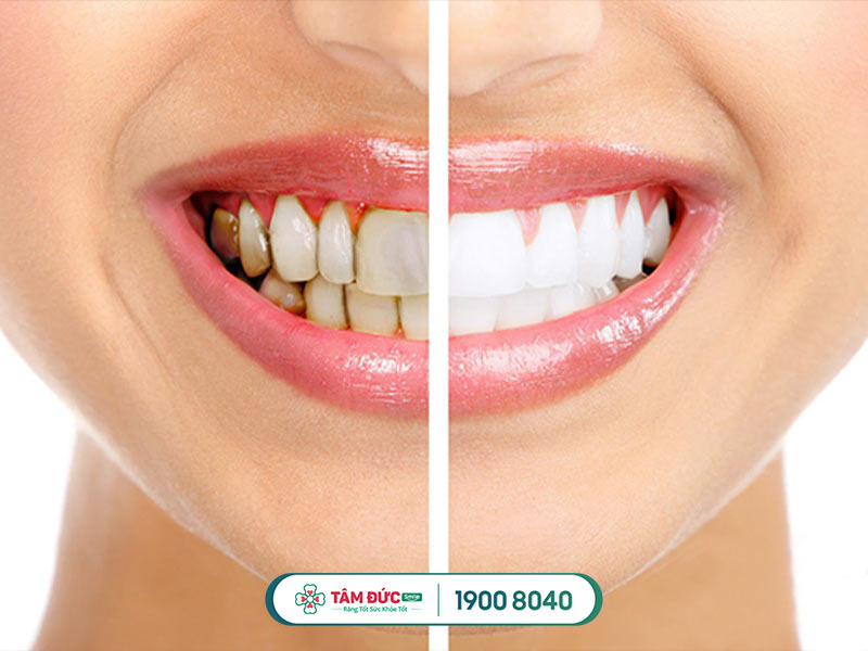 Nên tẩy trắng cho trường hợp răng bị ố vàng