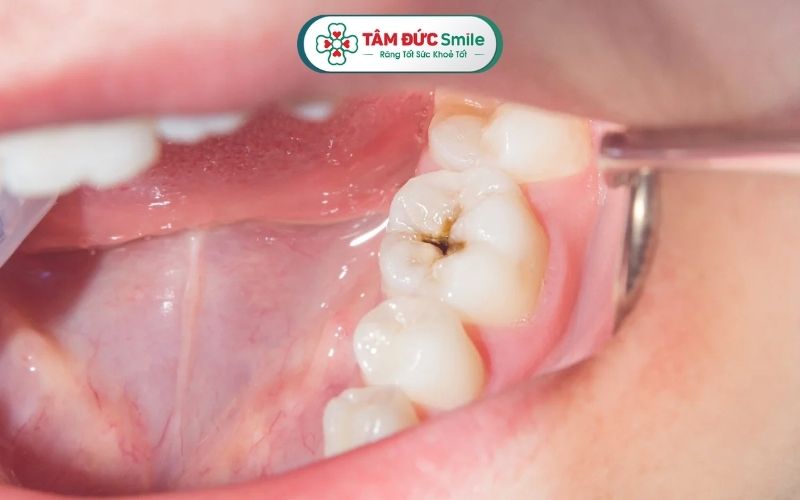 "Con sâu răng" thực chất là bệnh lý sâu răng - hệ quả sự tấn công của hại khuẩn vào trong răng