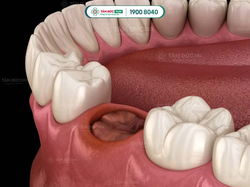 Cục máu đông ngăn cản vi khuẩn và thức ăn rơi vào ổ răng