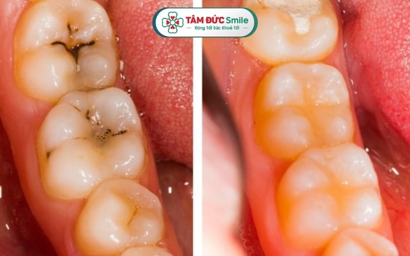 Trám răng thường ít gây đau, bác sĩ có thể gây tê khi cần để giảm cảm giác ê buốt, khó chịu