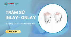 Trám sứ Inlay - Onlay là kỹ thuật phục hình sử dụng miếng sứ chế tác riêng biệt để thay thế cho phần mô răng đã mất.