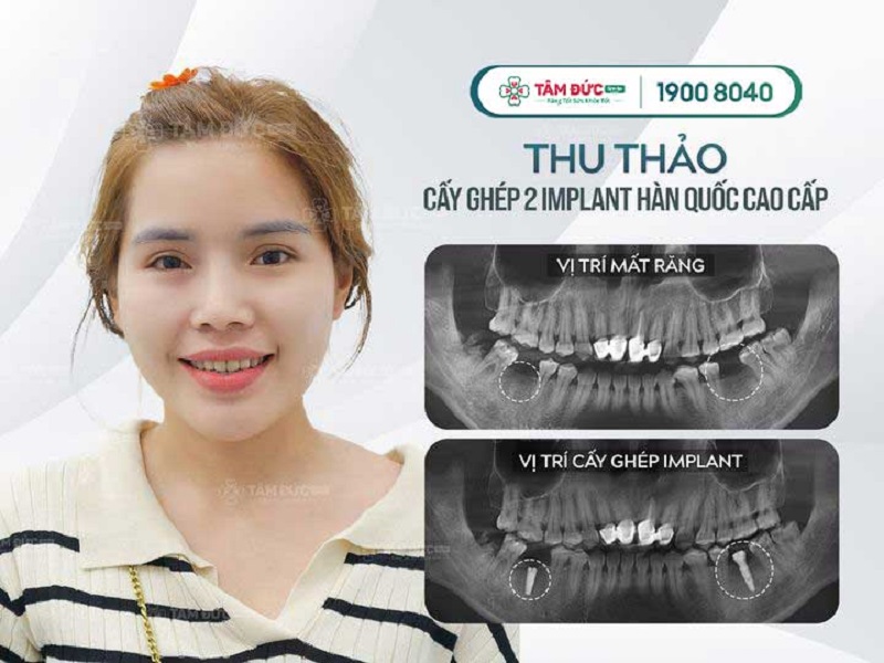 Mất răng làm ảnh hưởng chất lượng bữa ăn