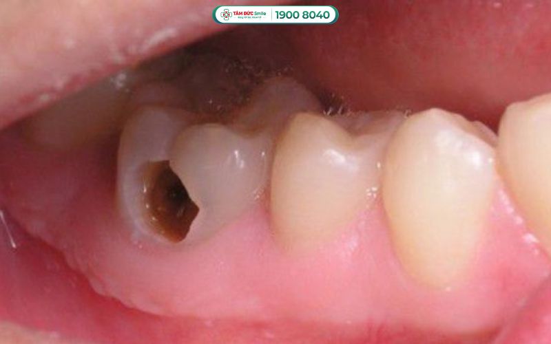 Sâu răng nặng vào đến tủy do không điều trị kịp thời