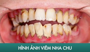 Viêm nha chu là tình trạng nướu bị sưng đỏ, chảy máu và hôi miệng do thói quen vệ sinh không đúng cách