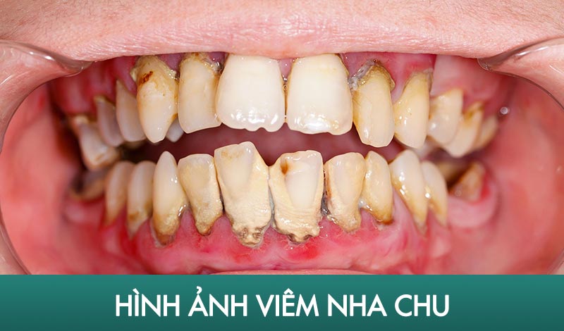 Viêm nha chu là tình trạng nướu bị sưng đỏ, chảy máu và hôi miệng do thói quen vệ sinh không đúng cách