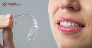 phương pháp sử dụng các khí cụ chỉnh nha đơn giản, khay niềng silicon, hoặc máng nhựa tháo lắp