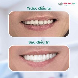 Phủ răng sứ - đổi mới nụ cười