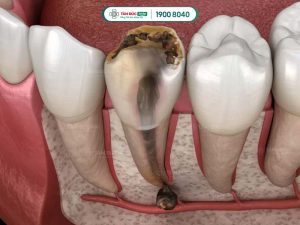 Răng chết tuỷ để lâu dẫn đến nhiễm trùng chóp răng, lan rộng ra xung quanh