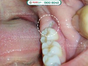 Mọc răng khôn dẫn đến viêm nướu