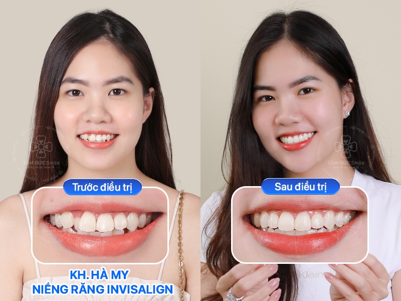 Hình ảnh trước và sau niềng răng Invisalign của khách hàng Hà My