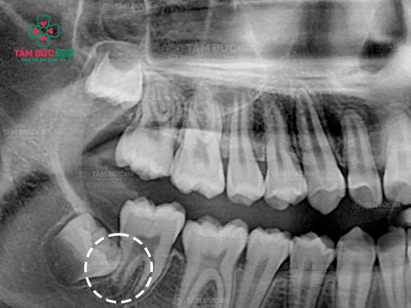 Răng khôn mọc đâm vào răng số 7
