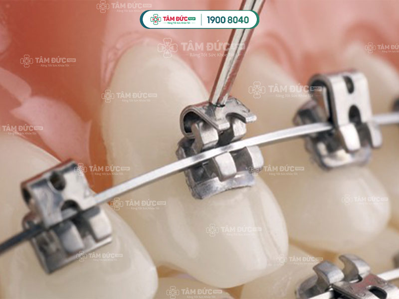 Mắc cài tự đóng
