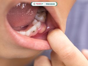 Áp xe nướu răng