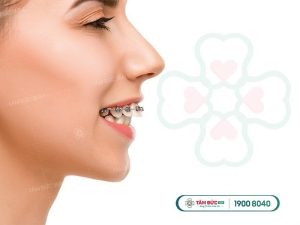 Làm răng sứ có bớt hô không?
