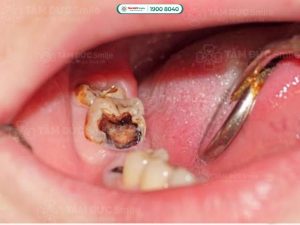 Khi viêm tủy, bạn có cảm giác đau nhức dữ dội, đau mãi không khỏi