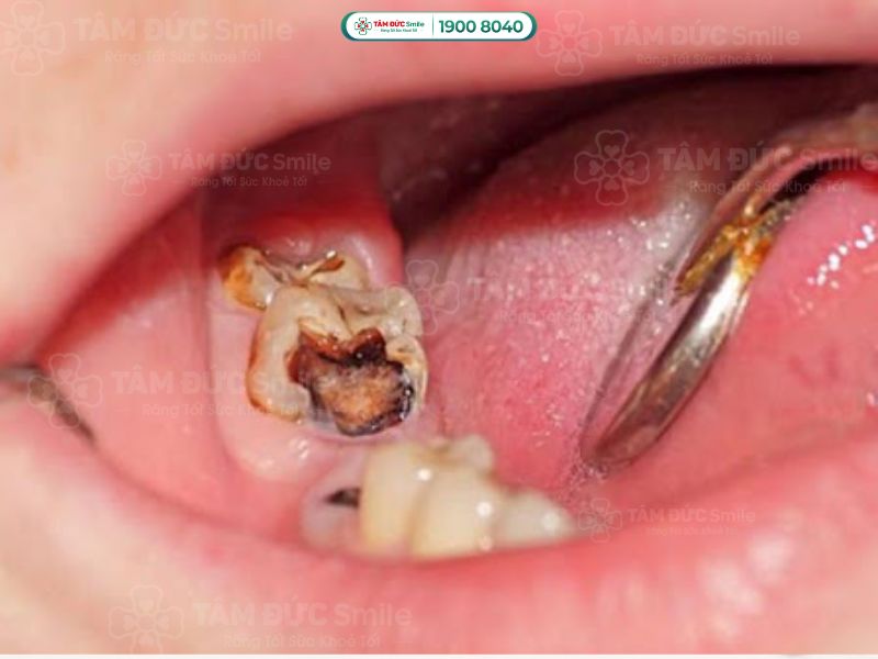 Khi viêm tủy, bạn có cảm giác đau nhức dữ dội, đau mãi không khỏi
