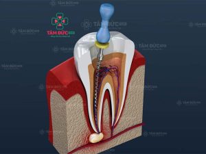 Lấy tuỷ răng xong cần có chế độ ăn uống kiêng khem phù hợp