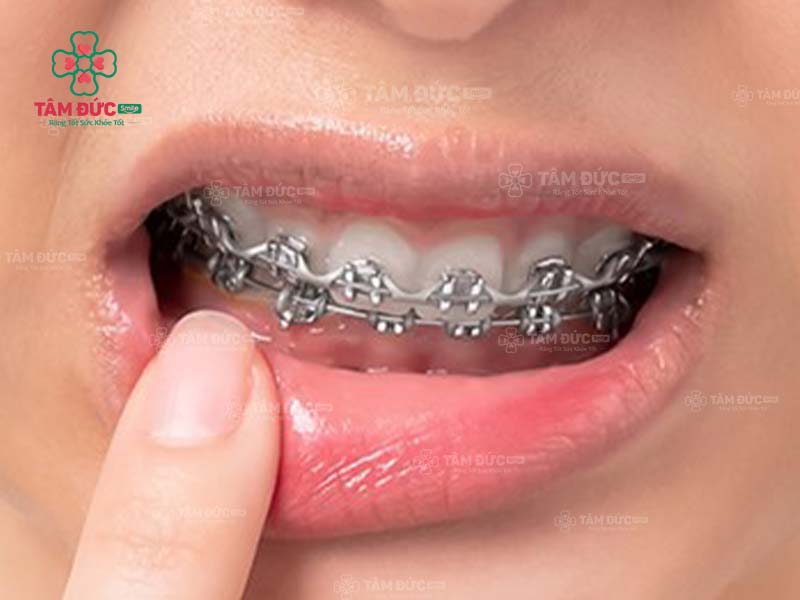 Niềng răng sai cách làm tăng tỷ lệ thất bại sau khi tháo niềng