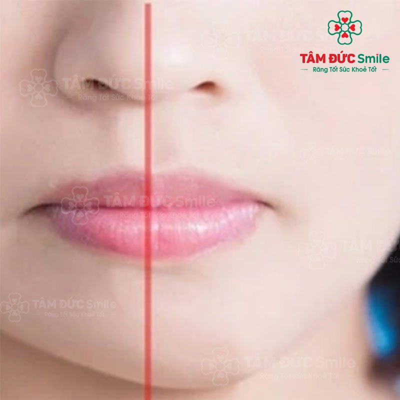 Khuôn mặt lệch, mất cân xứng